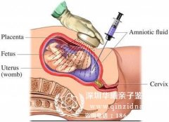 哪里可以抽羊水做亲子鉴定