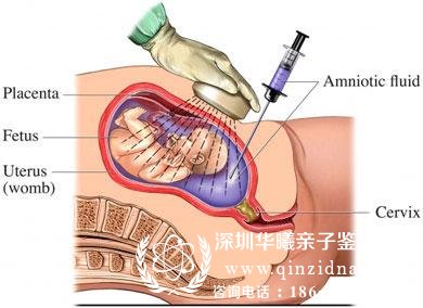 <a data-cke-saved-href=http://www.qinzidna.com/jigou/2015227.html href=http://www.qinzidna.com/jigou/2015227.html target=_blank ><a href=http://www.qinzidna.com/jigou/2015227.html target=_blank >哪里可以抽羊水做亲子鉴定</a></a>