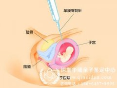 广东哪个医院能做羊水穿刺验DNA