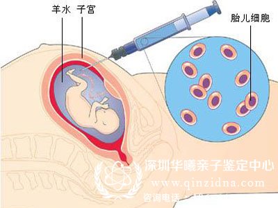 <a data-cke-saved-href=http://www.qinzidna.com/anli/2015249.html href=http://www.qinzidna.com/anli/2015249.html target=_blank >羊水穿刺验亲子关系准确率多少</a>