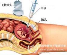 深圳哪家医院可以做羊水穿刺亲子鉴定