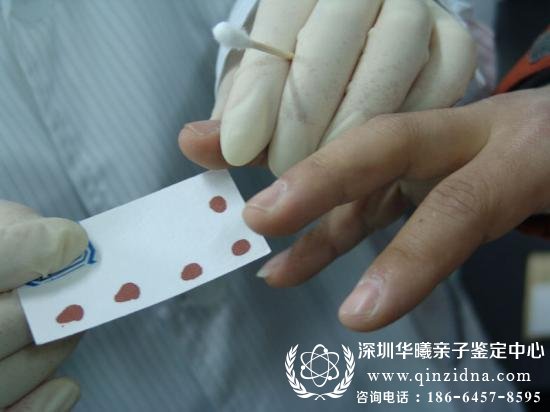 <a data-cke-saved-href=http://www.qinzidna.com/ href=http://www.qinzidna.com/ target=_blank ><a href=http://www.qinzidna.com/ target=_blank >DNA亲子鉴定</a></a>采样