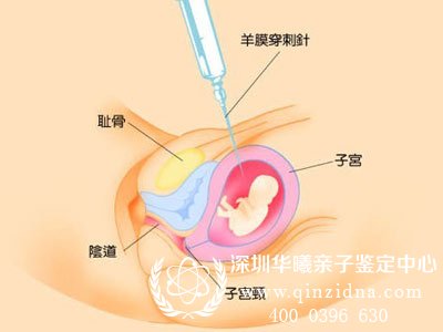 抽羊水检查亲子鉴定要多少钱