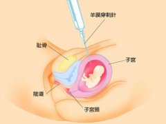 腹中胎儿亲子鉴定抽羊水疼吗