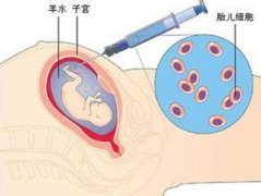 什么叫抽羊水，疼不疼