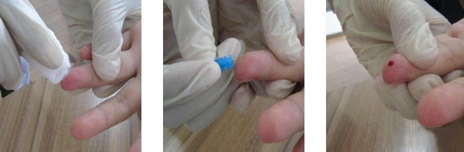 亲子鉴定血痕样本采集步骤