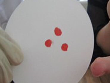 血液血痕作为亲子鉴定检测样本