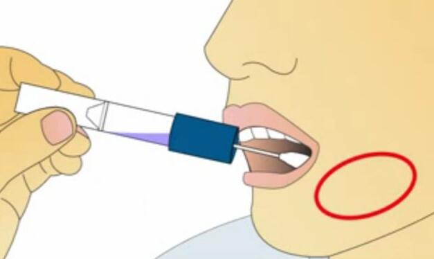 口腔拭子采样 口腔拭子采样