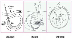 哪些孕妇不适合无创产前亲子鉴定